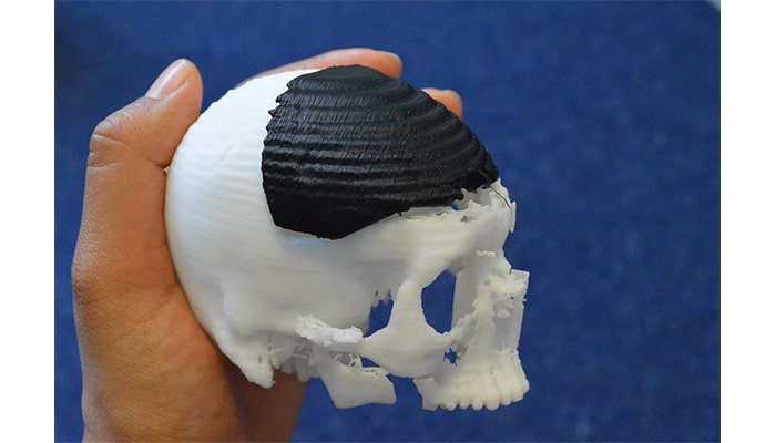 3D printing has enabled surgeons to print grafts precisely for every individual scenario, and in the process eliminated expensive new moulds while saving precious time.